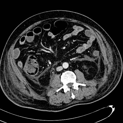 File:Acute pancreatic necrosis (Radiopaedia 13560-13486 Axial C+ portal venous phase 87).jpg