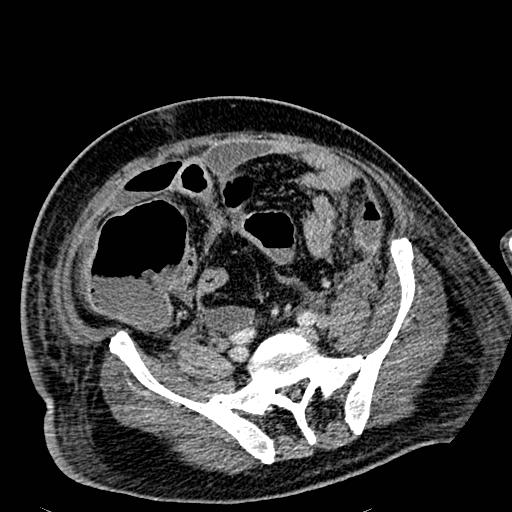 File:Acute pancreatic necrosis (Radiopaedia 13560-18501 Axial C+ portal venous phase 106).jpg