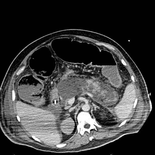 File:Acute pancreatic necrosis (Radiopaedia 13560-18501 Axial C+ portal venous phase 44).jpg