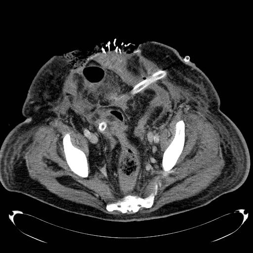 Acute pancreatic necrosis (Radiopaedia 13560-18503 Axial C+ portal venous phase 70).jpg