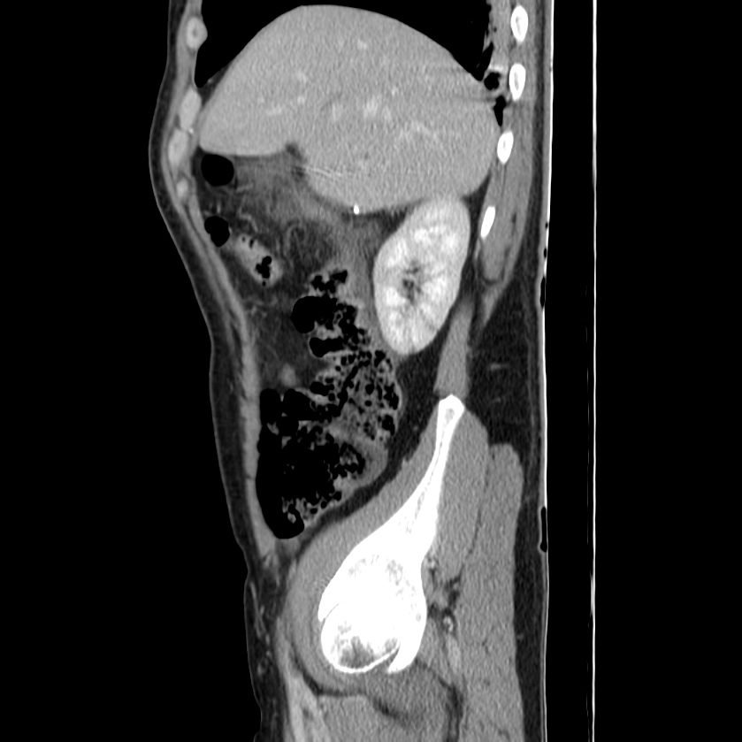 Acute pancreatitis (Radiopaedia 22572-22596 Sagittal C+ portal venous phase 14).jpg