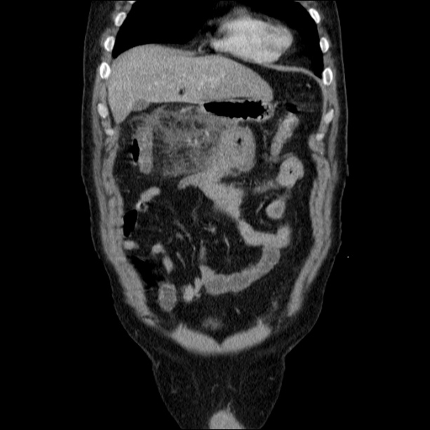 Acute pancreatitis (Radiopaedia 26663-26813 Coronal C+ portal venous phase 17).jpg