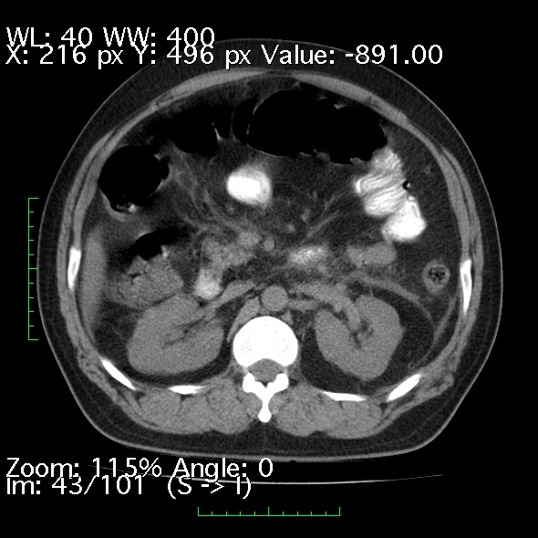 File:Acute pancreatitis (Radiopaedia 34043-35276 Axial non-contrast 43).jpg