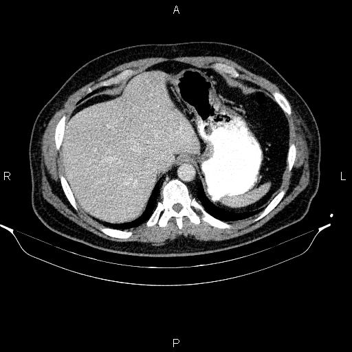 File:Acute pancreatitis (Radiopaedia 85390-101010 Axial C+ portal venous phase 17).jpg