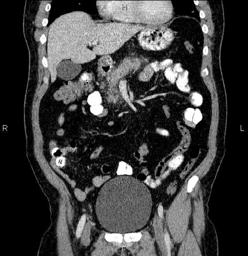 Acute pancreatitis (Radiopaedia 85390-101010 Coronal C+ portal venous phase 23).jpg