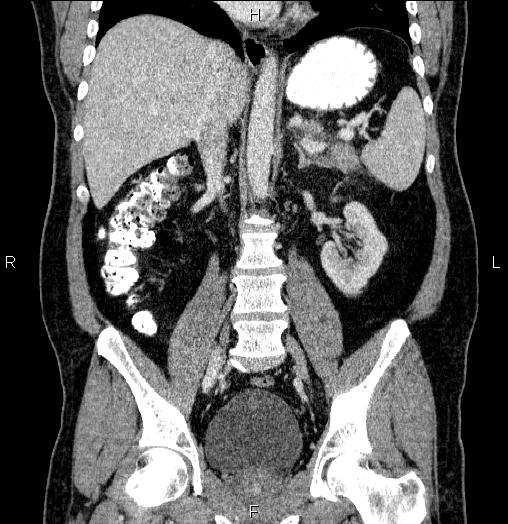 Acute pancreatitis (Radiopaedia 85390-101010 Coronal C+ portal venous phase 42).jpg