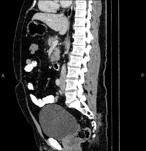 File:Acute pancreatitis (Radiopaedia 85390-101010 Sagittal C+ portal venous phase 49).jpg
