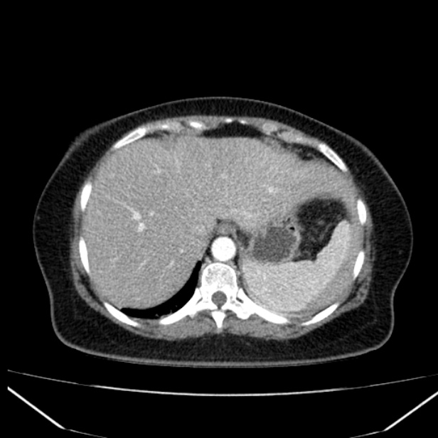 Acute pancreatitis - Balthazar C (Radiopaedia 26569-26714 Axial C+ arterial phase 15).jpg