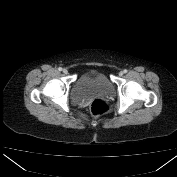 Acute pancreatitis - Balthazar C (Radiopaedia 26569-26714 Axial C+ portal venous phase 92).jpg
