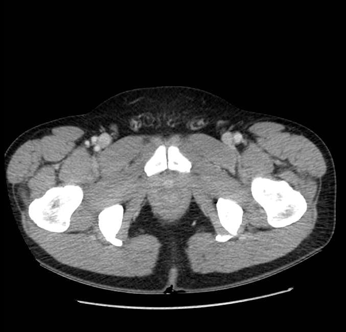 Acute pancreatitis - Balthazar E (Radiopaedia 23080-23110 Axial C+ portal venous phase 76).jpg