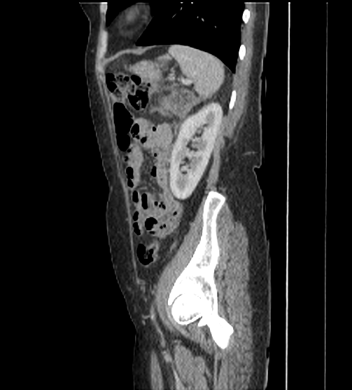 File:Acute pancreatitis - Balthazar E - post ERCP (Radiopaedia 27562-27772 Sagittal C+ portal venous phase 104).png