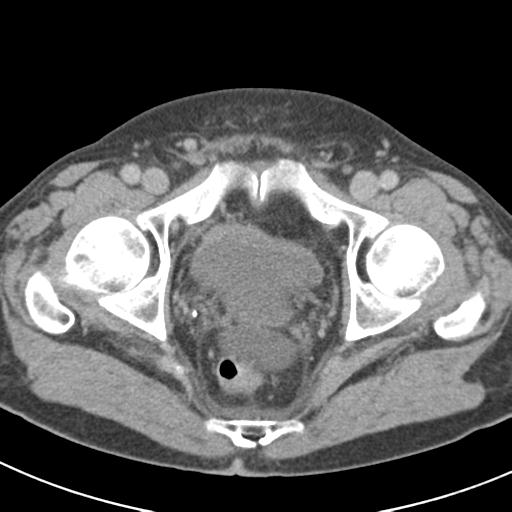 Acute pancreatitis and walled-off necrosis (Radiopaedia 29888-30403 Axial C+ delayed 79).jpg