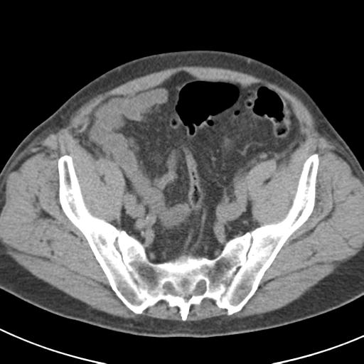 File:Acute pancreatitis and walled-off necrosis (Radiopaedia 29888-30403 Axial non-contrast 61).jpg