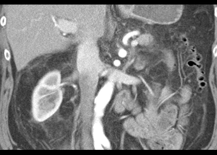 File:Acute pancreatitis and walled-off necrosis (Radiopaedia 29888-30403 Coronal C+ portal venous phase 31).jpg