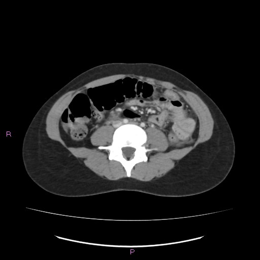 File:Acute pancreatitis secondary to stone at minor papilla and pancreatic divisum (Radiopaedia 76570-88333 Axial C+ portal venous phase 45).jpg