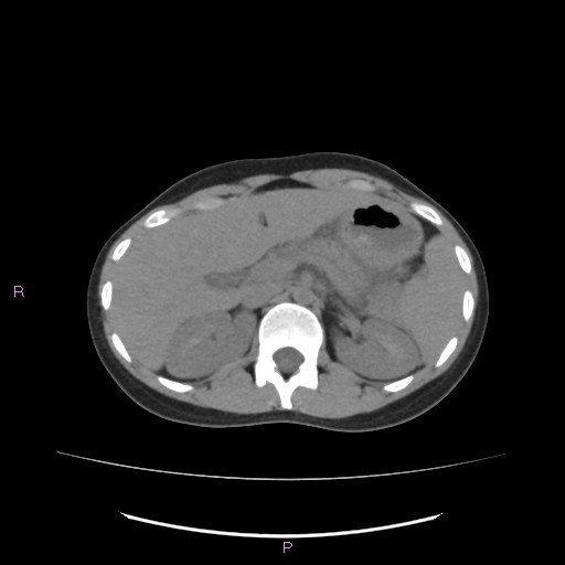 Acute pancreatitis secondary to stone at minor papilla and pancreatic divisum (Radiopaedia 76570-88333 Axial non-contrast 22).jpg