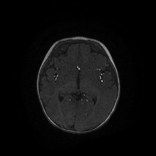 Acute phase of hemiconvulsion-hemiplegia epilepsy syndrome (Radiopaedia 29309-29745 Axial TOF angiography 63).jpg