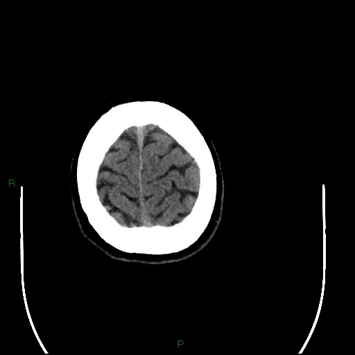 Acute posterior cerebral artery territory infarct (Radiopaedia 79329-92393 Axial non-contrast 102).jpg