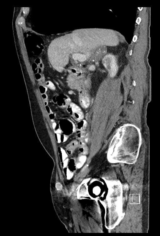 Acute renal infarction - rim capsular enhancement (Radiopaedia 59833-67270 Sagittal C+ portal venous phase 61).jpg