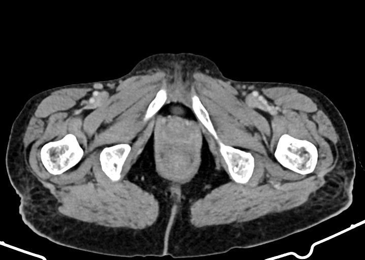 Acute small bowel (ileal) volvulus (Radiopaedia 71740-82139 Axial C+ portal venous phase 208).jpg