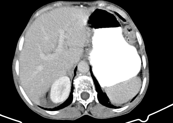 Acute small bowel (ileal) volvulus (Radiopaedia 71740-82139 Axial C+ portal venous phase 57).jpg