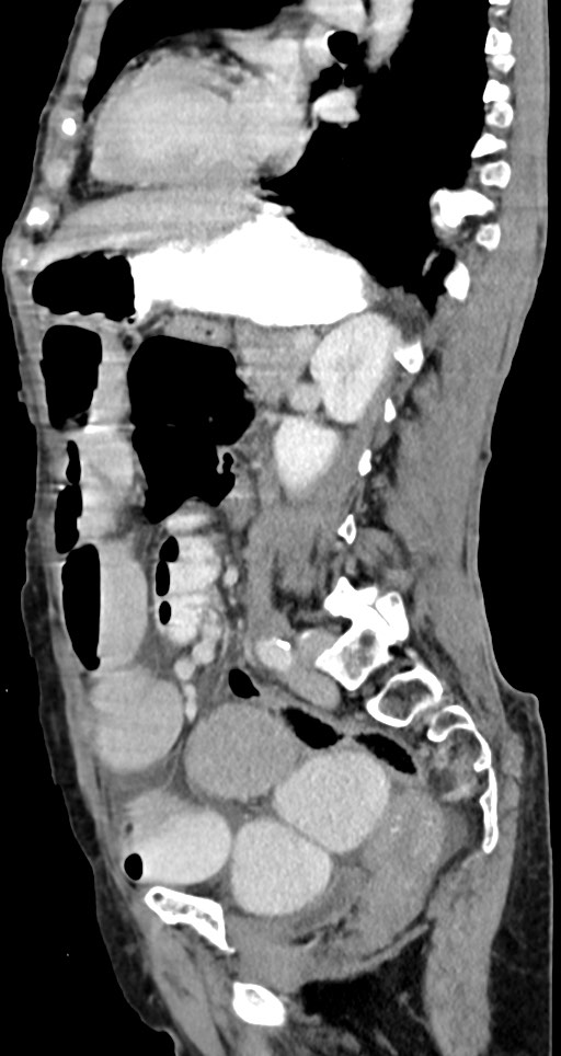 Acute small bowel (ileal) volvulus (Radiopaedia 71740-82139 Sagittal C+ portal venous phase 72).jpg