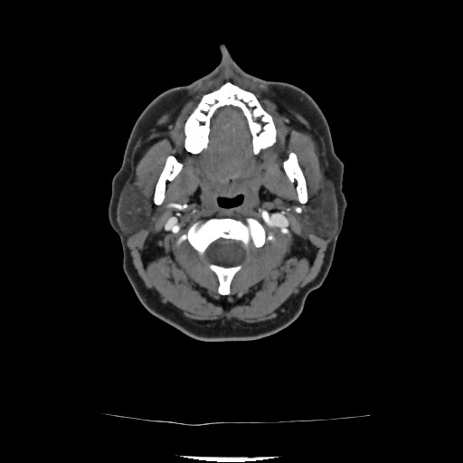 Acute subarachnoid hemorrhage and accessory anterior cerebral artery (Radiopaedia 69231-79009 Axial C+ arterial phase 66).jpg
