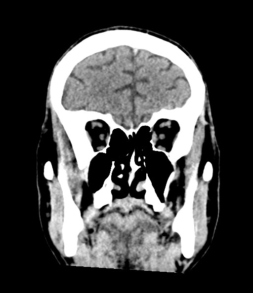 File:Acute superior cerebellar artery territory infarct (Radiopaedia 84104-99359 Coronal non-contrast 32).jpg
