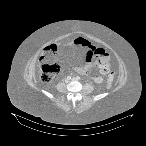 Acute superior mesenteric artery occlusion (Radiopaedia 51288-56960 Axial lung window 43).jpg