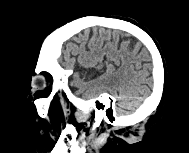 Acute traumatic subdural hematoma (Radiopaedia 82921-97257 Sagittal non-contrast 21).jpg
