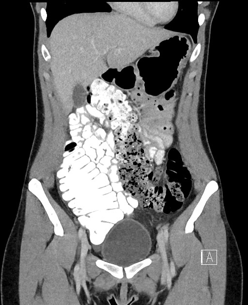 Acute uncomplicated appendicitis (Radiopaedia 61374-69304 Coronal C+ portal venous phase 29).jpg