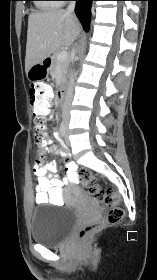Acute uncomplicated appendicitis (Radiopaedia 61374-69304 Sagittal C+ portal venous phase 53).jpg