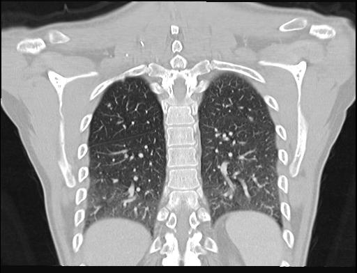 File:Addison disease (Radiopaedia 49318-54412 Coronal lung window 8).jpg
