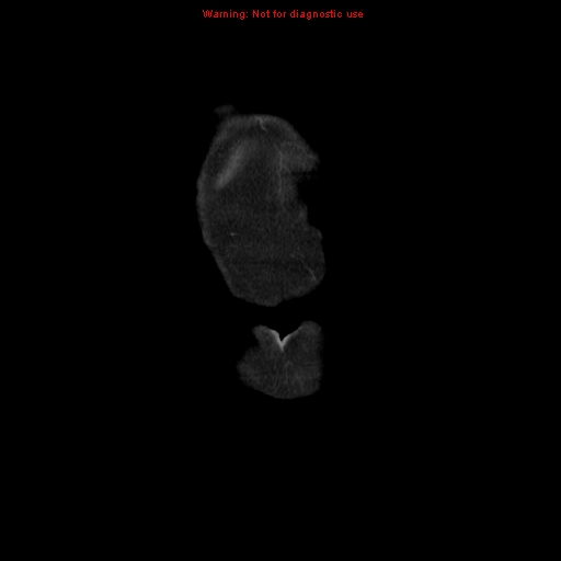 File:Adenocarcinoma of the colon (Radiopaedia 8191-9039 Coronal liver window 1).jpg
