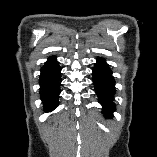 Adenocarcinoma of the lung (Radiopaedia 59871-67325 Coronal C+ arterial phase 68).jpg