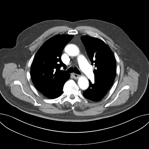 File:Adenocarcioma of rectum- T1 lesion (Radiopaedia 36921-38547 Axial C+ arterial phase 23).png