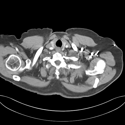 Adenocarcioma of rectum- T1 lesion (Radiopaedia 36921-38547 Axial C+ arterial phase 5).png