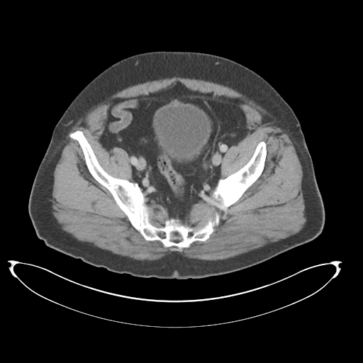 Adenocarcioma of rectum- T1 lesion (Radiopaedia 36921-38547 Axial C+ portal venous phase 73).png