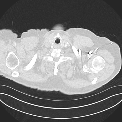 Adenocarcioma of rectum- T1 lesion (Radiopaedia 36921-38547 Axial lung window 3).png