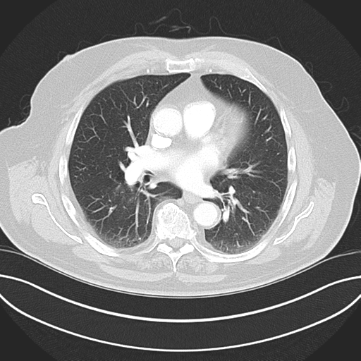 Adenocarcioma of rectum- T1 lesion (Radiopaedia 36921-38547 Axial lung window 30).png