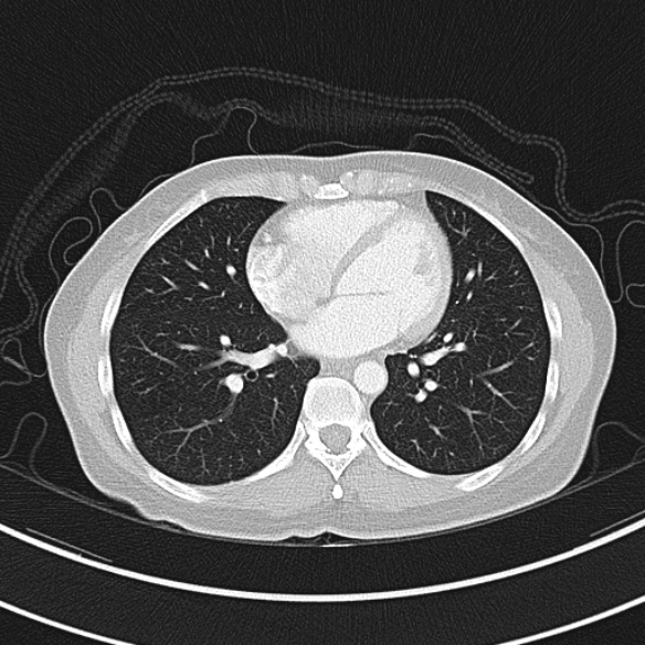 Adenocystic carcinoma of the trachea (Radiopaedia 47677-52525 Axial lung window 60).jpg