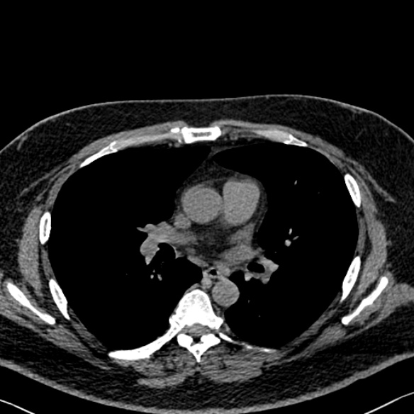 Adenoid cystic carcinoma of the trachea (Radiopaedia 49042-54137 Axial non-contrast 171).jpg