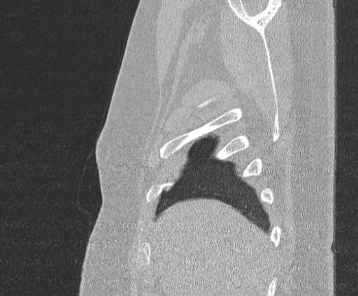 Adenoid cystic carcinoma of the trachea (Radiopaedia 49042-54137 Sagittal lung window 49).jpg