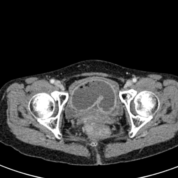 Adhesional small bowel obstruction (Radiopaedia 48397-53305 Axial C+ portal venous phase 89).jpg