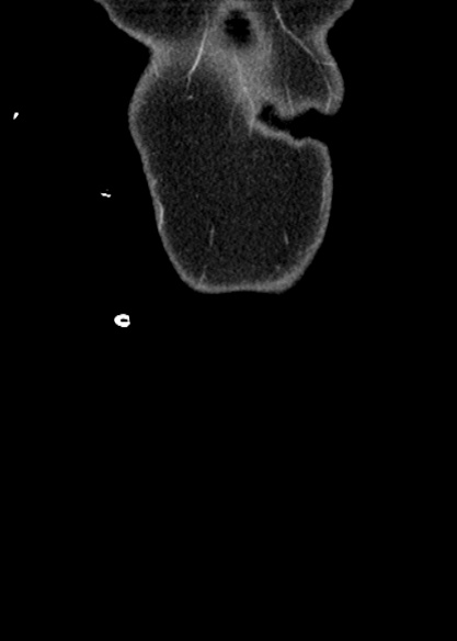 Adhesional small bowel obstruction (Radiopaedia 48397-53305 Coronal C+ portal venous phase 11).jpg