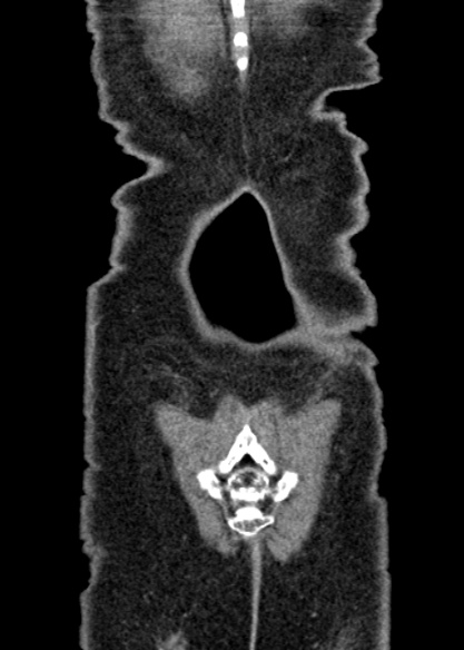 Adhesional small bowel obstruction (Radiopaedia 48397-53305 Coronal C+ portal venous phase 337).jpg