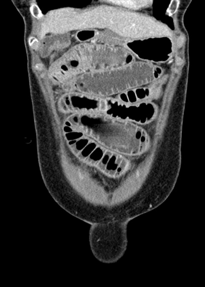 Adhesional small bowel obstruction (Radiopaedia 48397-53305 Coronal C+ portal venous phase 65).jpg