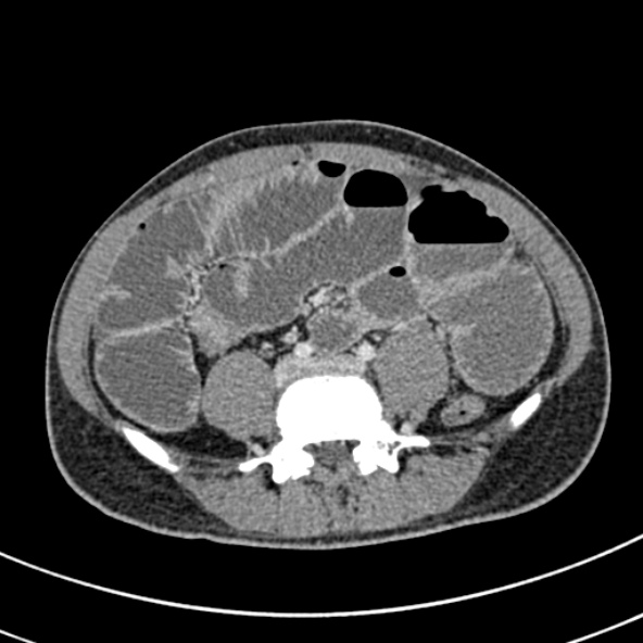 Adhesional small bowel obstruction (Radiopaedia 52107-57980 Axial C+ portal venous phase 81).jpg
