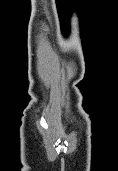 Adhesional small bowel obstruction (Radiopaedia 52107-57980 Coronal C+ portal venous phase 79).jpg