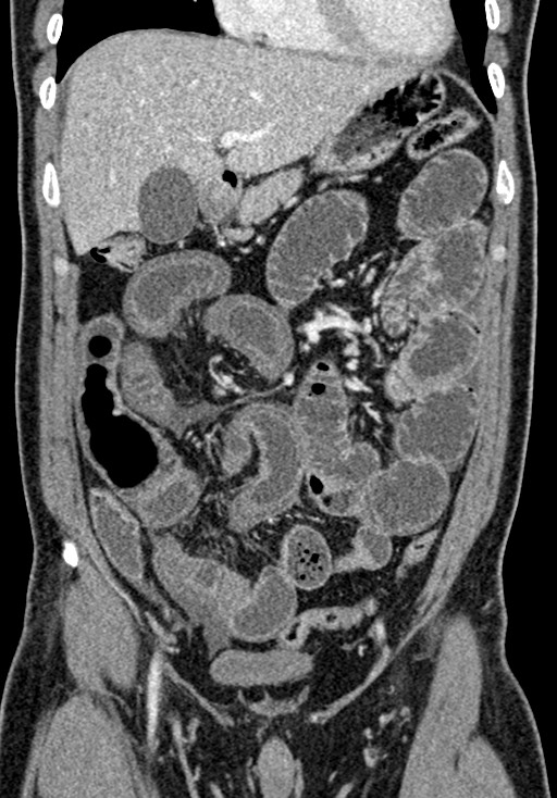 Adhesional small bowel obstruction (Radiopaedia 58900-66131 Coronal C+ portal venous phase 108).jpg